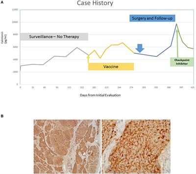 A Case Report of Sequential Use of a Yeast-CEA Therapeutic Cancer Vaccine and Anti-PD-L1 Inhibitor in Metastatic Medullary Thyroid Cancer